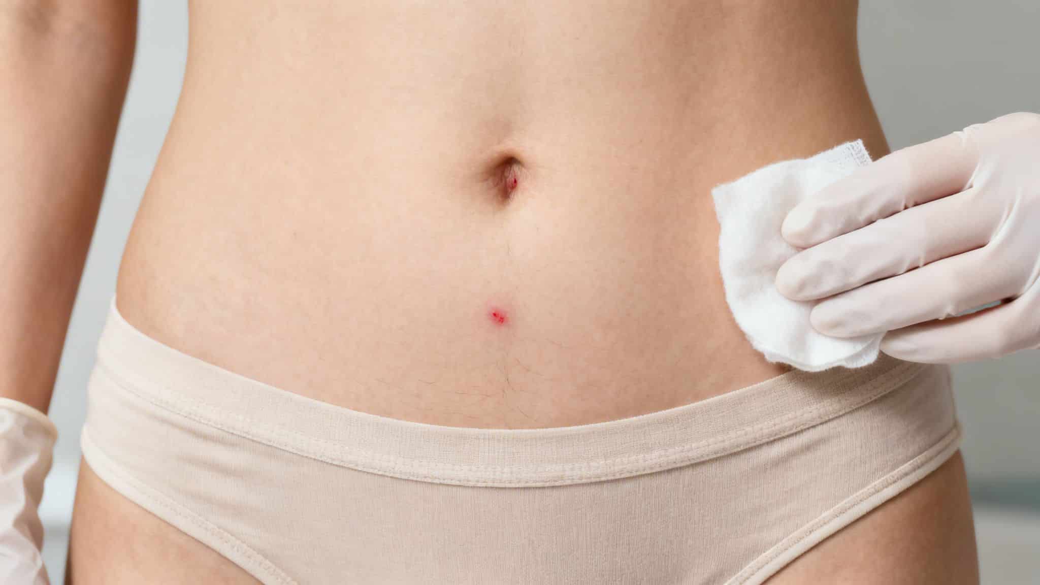 Gros plan sur l'abdomen d'une personne avec une tache rouge et une main gantée nettoyant la peau avec un coton.