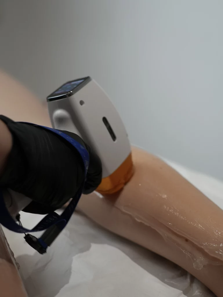 laser pour epilation