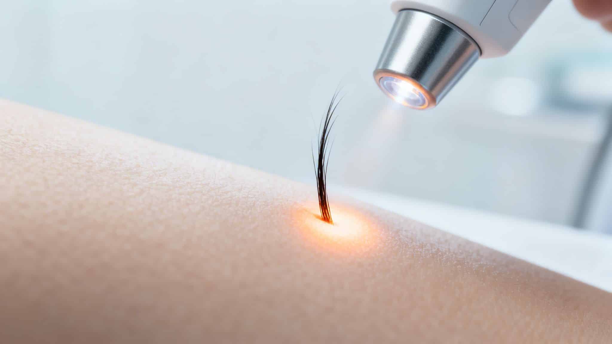 Gros plan d'un appareil laser ciblant un poil unique sur la peau, créant une zone lumineuse et chaude.