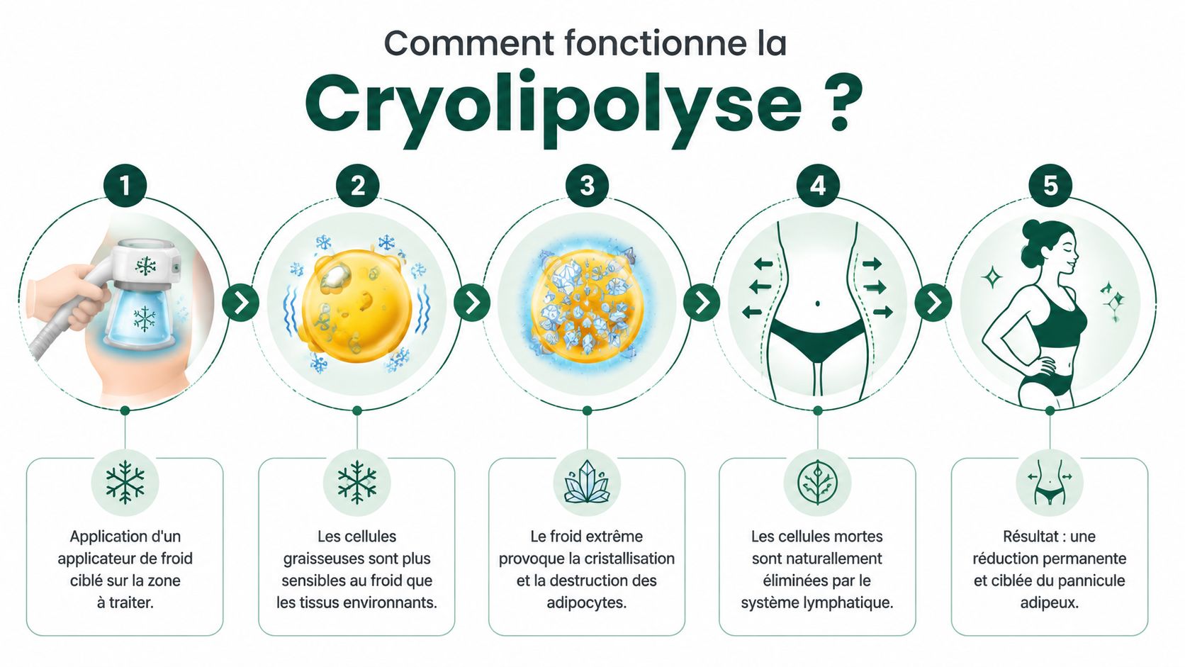 Schéma explicatif en cinq étapes montrant le processus scientifique de la cryolipolyse pour réduire la graisse localisée.