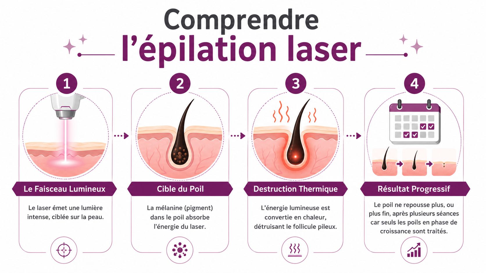 Schéma illustrant les quatre étapes du fonctionnement de l'épilation laser sur la peau humaine et le poil.