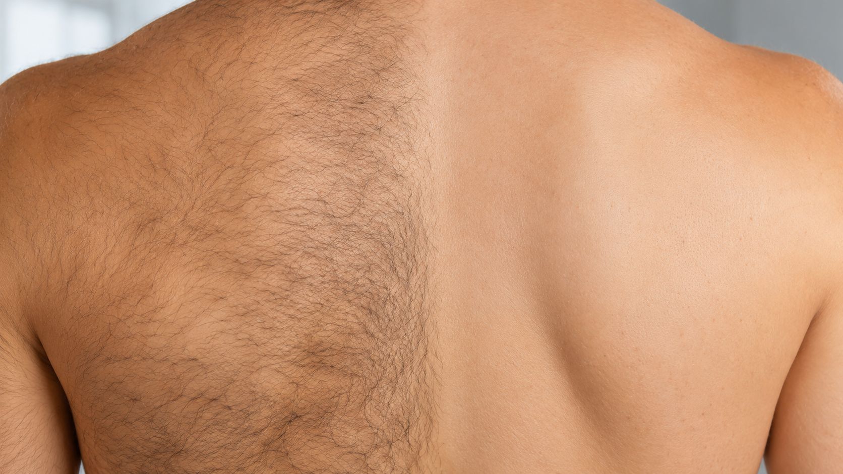 Comparaison du dos d'un homme avant et après une séance d'épilation laser pour éliminer les poils.