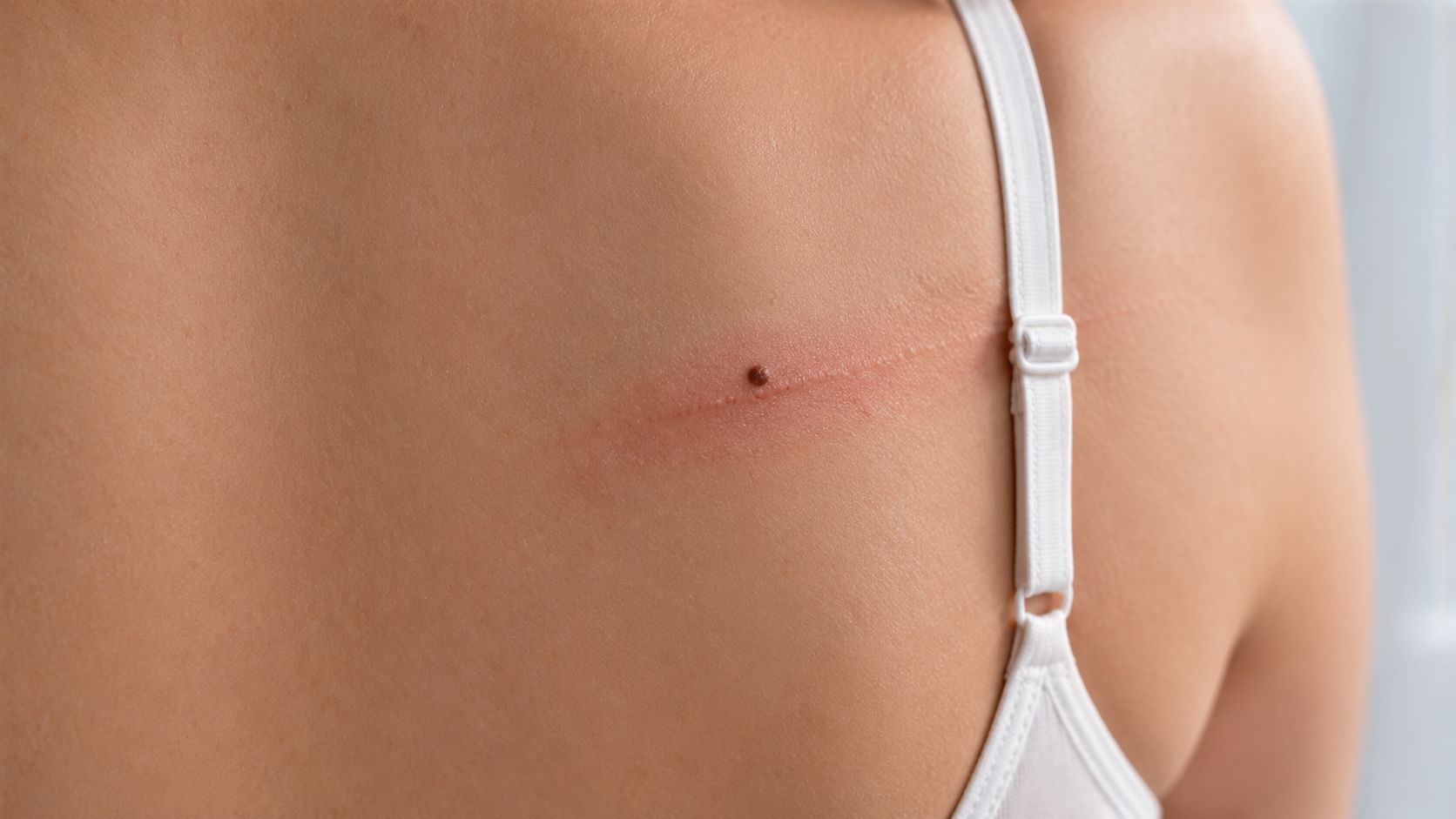 Vue rapprochée d'un grain de beauté sur le dos d'une femme avec une irritation rouge cutanée